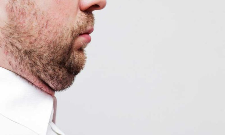 غبغب چیست؟ (از کجا بفهمیم غبغب داریم؟)