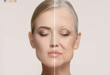 بررسی انواع لیزر برای جوانسازی پوست