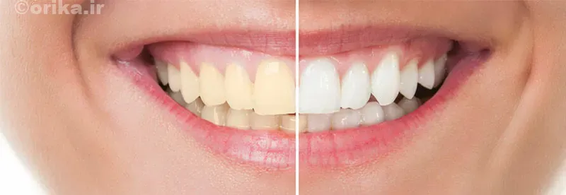 سفید کردن فوری دندان در خانه
