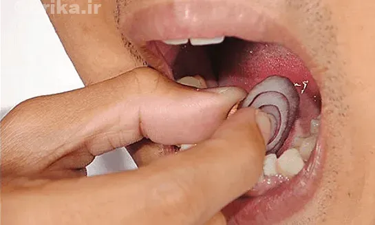 درمان دندان درد با پیاز