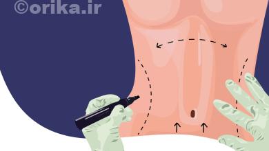 جراحی زیبایی شکم و پهلو یا ابدومینوپلاستی، نوعی عمل جراحی زیبایی است که برای حذف چربی و پوست اضافی و سفت کردن عضلات شکم انجام می‌شود