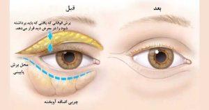 تاریخچه بلفاروپلاستی