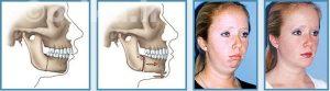 عوارض جراحی زیبایی فک