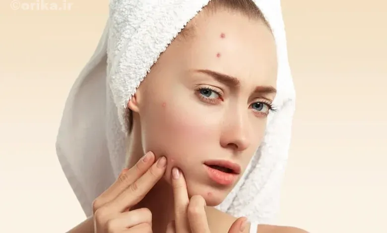 آیا کرم لایه بردار باعث از بین رفتن جوش می شود؟
