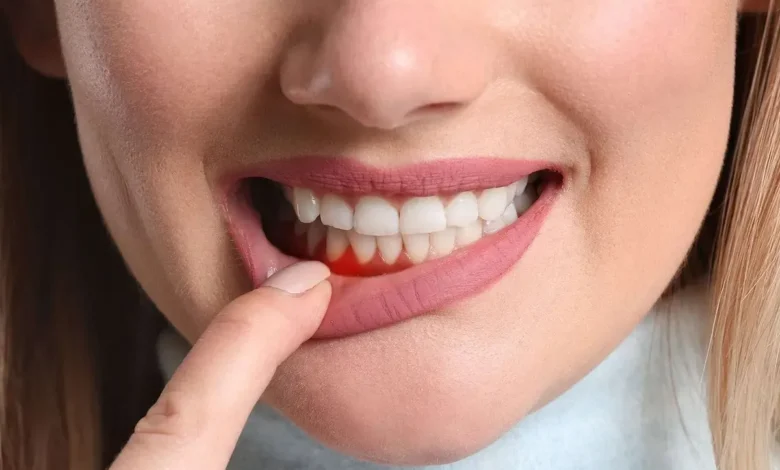 علت سیاه شدن لثه چیست؟ علل و راهکارهای پیشگیری