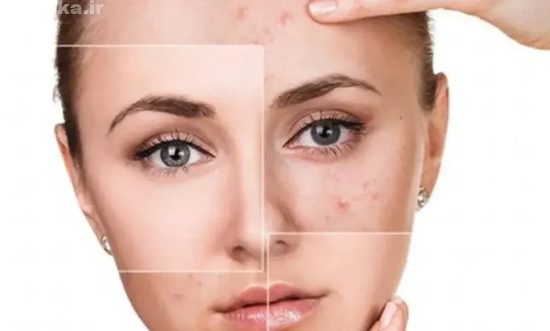 با چه لوازم آرایشی جوش را کاور کنیم؟