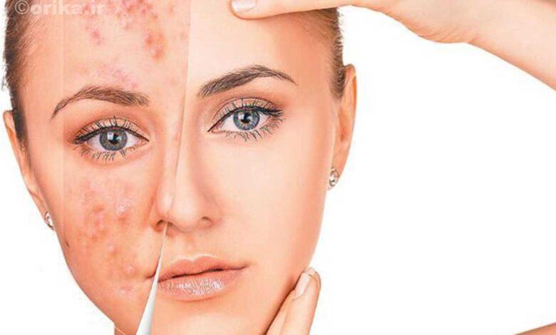 از بین بردن جوش صورت در یک روز