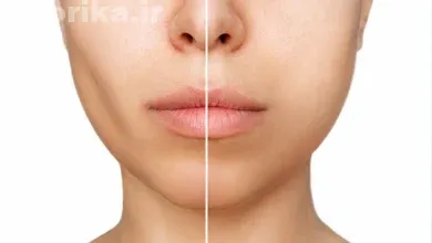 جراحی زیبایی هالوچیک