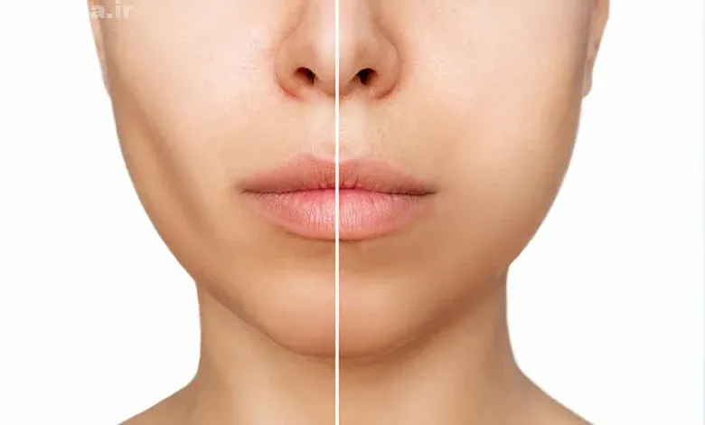 جراحی زیبایی هالوچیک