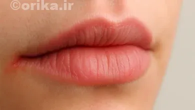 درمان التهاب گوشه لب