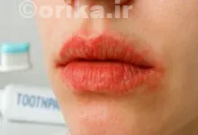 حساسیت لب به خمیردندان