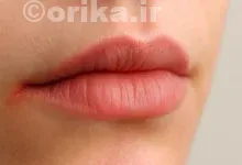 درمان التهاب گوشه لب
