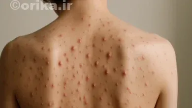 علل ایجاد جوش در بدن از صورت تا کمر