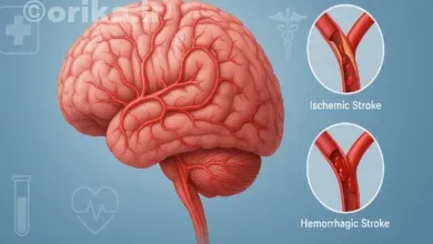 پیشگیری از سکته مغزی