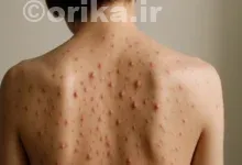 علل ایجاد جوش در بدن از صورت تا کمر