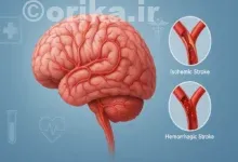 پیشگیری از سکته مغزی