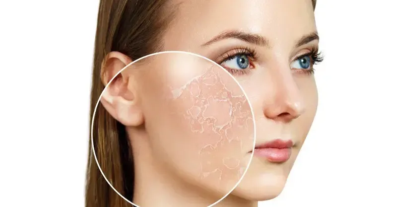 آشنایی با ویژگی‌های پوست خشک و حساس