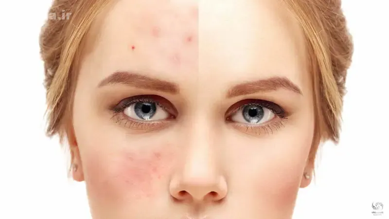 ارتباط DHT با آکنه، پوست چرب و مشکلات پوستی
