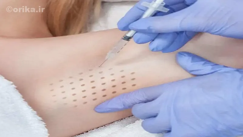 بوتاکس زیر بغل چیست و چگونه عمل می‌کند؟