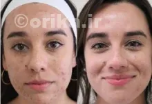 قرص راکوتان