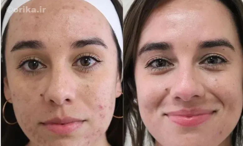 قرص راکوتان