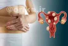 علائم یائسگی زودرس در سونوگرافی