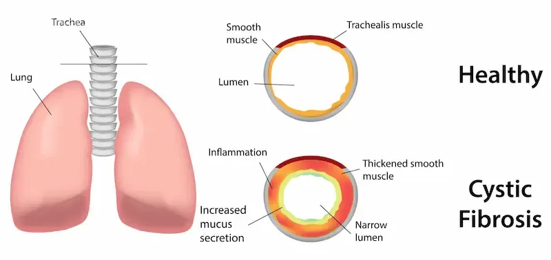 اندام‌های تحت تأثیر فیبروز کیستیک