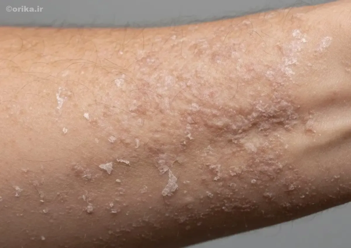 اگزما چیست؟