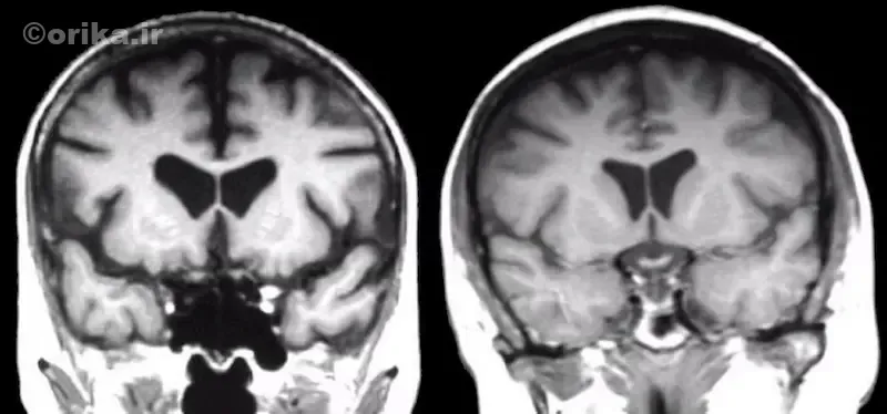 بیماری هانتینگتون چیست؟