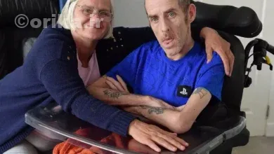  بیماری هانتینگتون