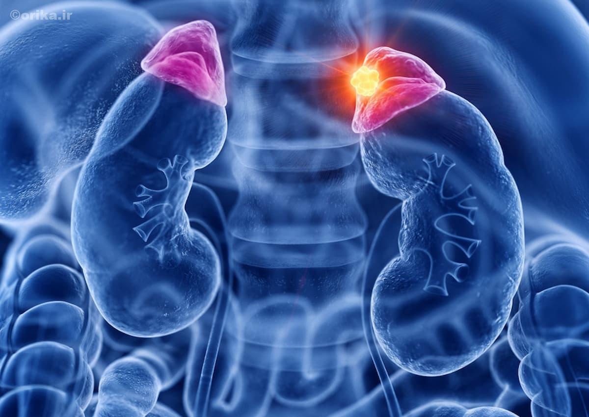 بیماری کورتیزول