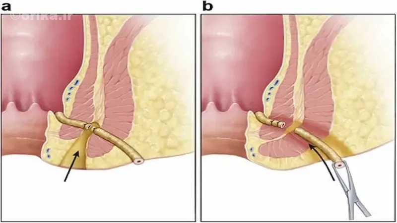 تشخیص و تصویربرداری تخصصی فیستول