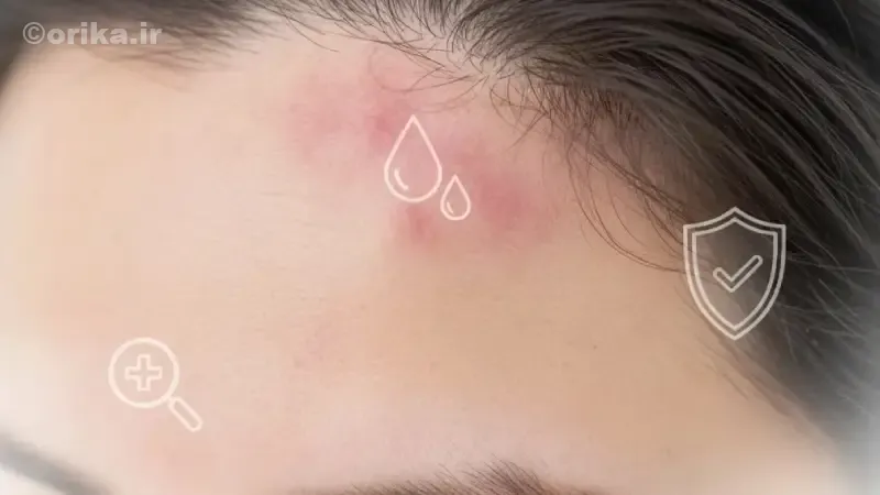 خارش سر بعد از رنگ مو چیست و چگونه ایجاد می‌شود