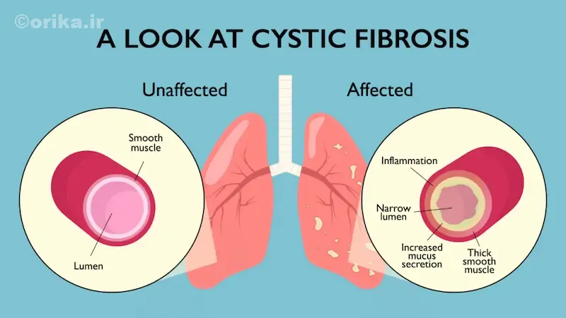 طول عمر و کیفیت زندگی بیماران CF