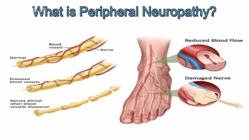 علائم و نشانه‌های شایع نوروپاتی 
