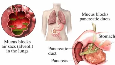 فیبروز کیستیک (CF) چیست؟ شناخت کامل بیماری، علائم و درمان نوین ژنتیکی