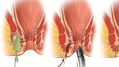 فیستول مقعدی در زنان