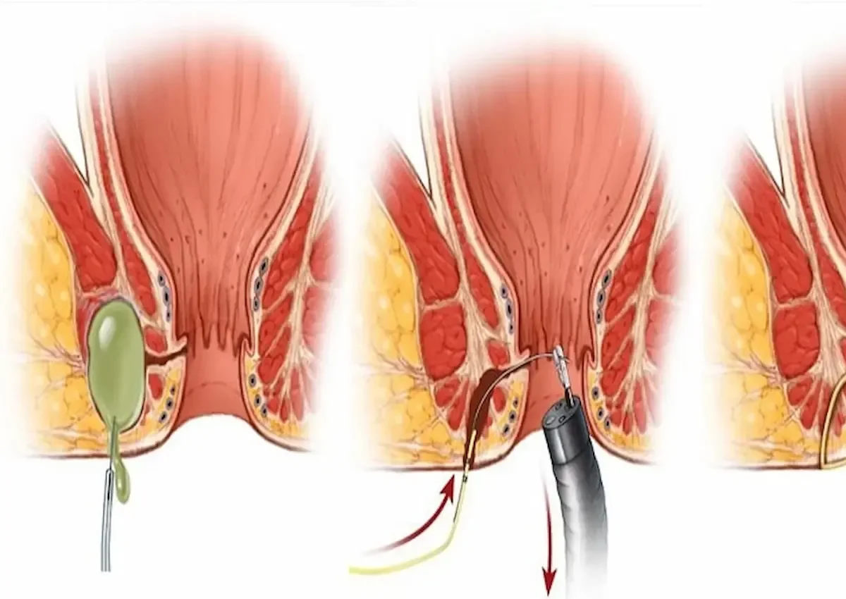 فیستول مقعدی در زنان