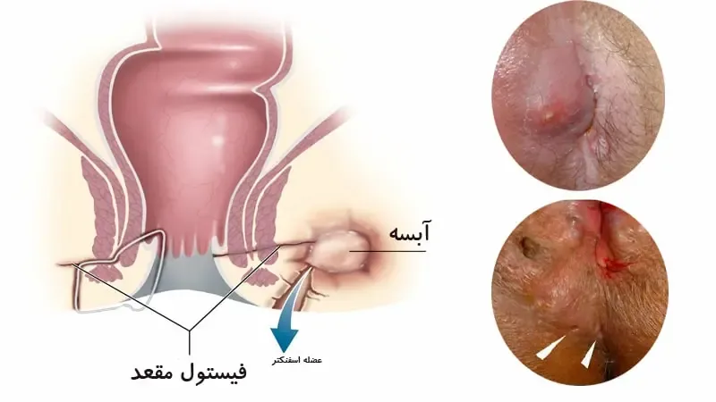 فیستول مقعدی چیست و چرا در زنان خاص‌تر است؟