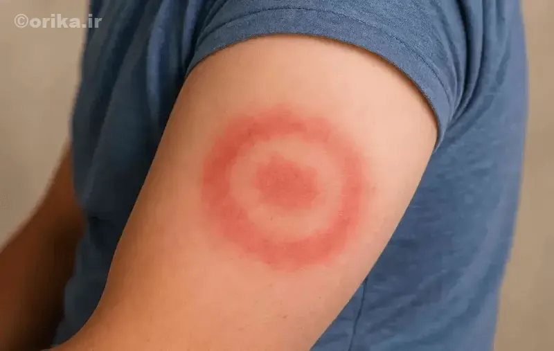 وضعیت بیماری لایم در ایران