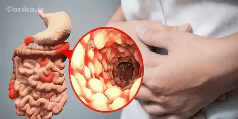 پیامدهای پساعفونت و مراقبت طولانی‌مدت بیماری جدید گوارشی