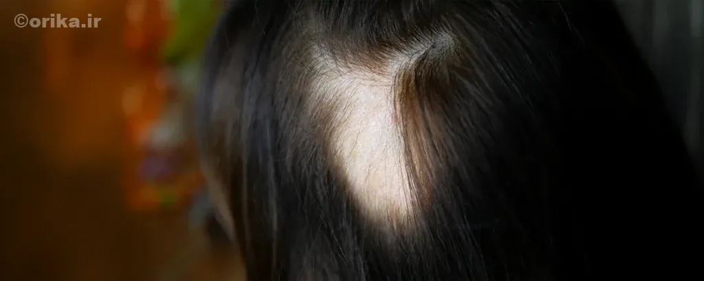 ریزش سکهای مو سر