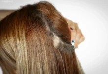 ریزش سکهای مو سر