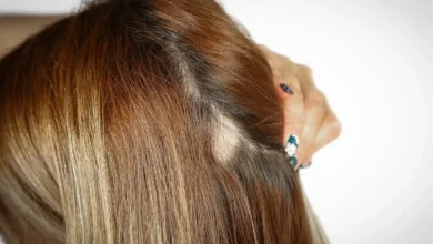 ریزش سکه‌ای مو سر