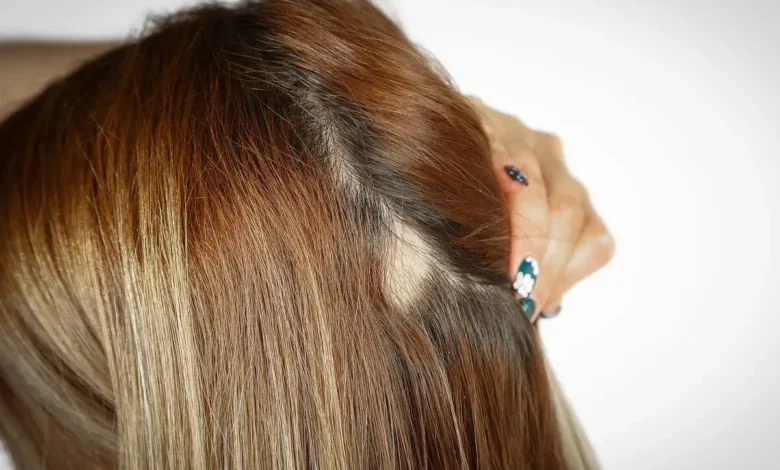 ریزش سکهای مو سر