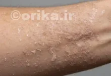 اگزما چیست؟