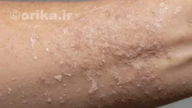 اگزما چیست؟