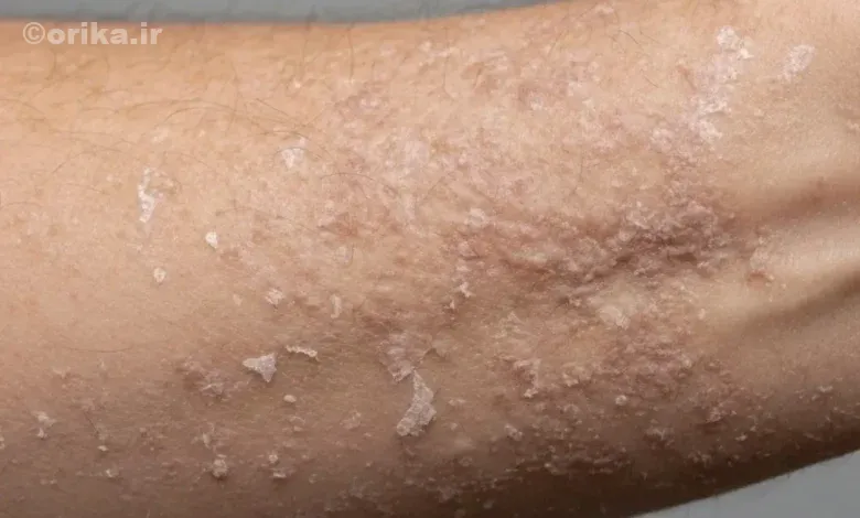 اگزما چیست؟