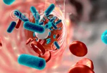 بیماری سپسیس چیست؟