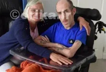  بیماری هانتینگتون